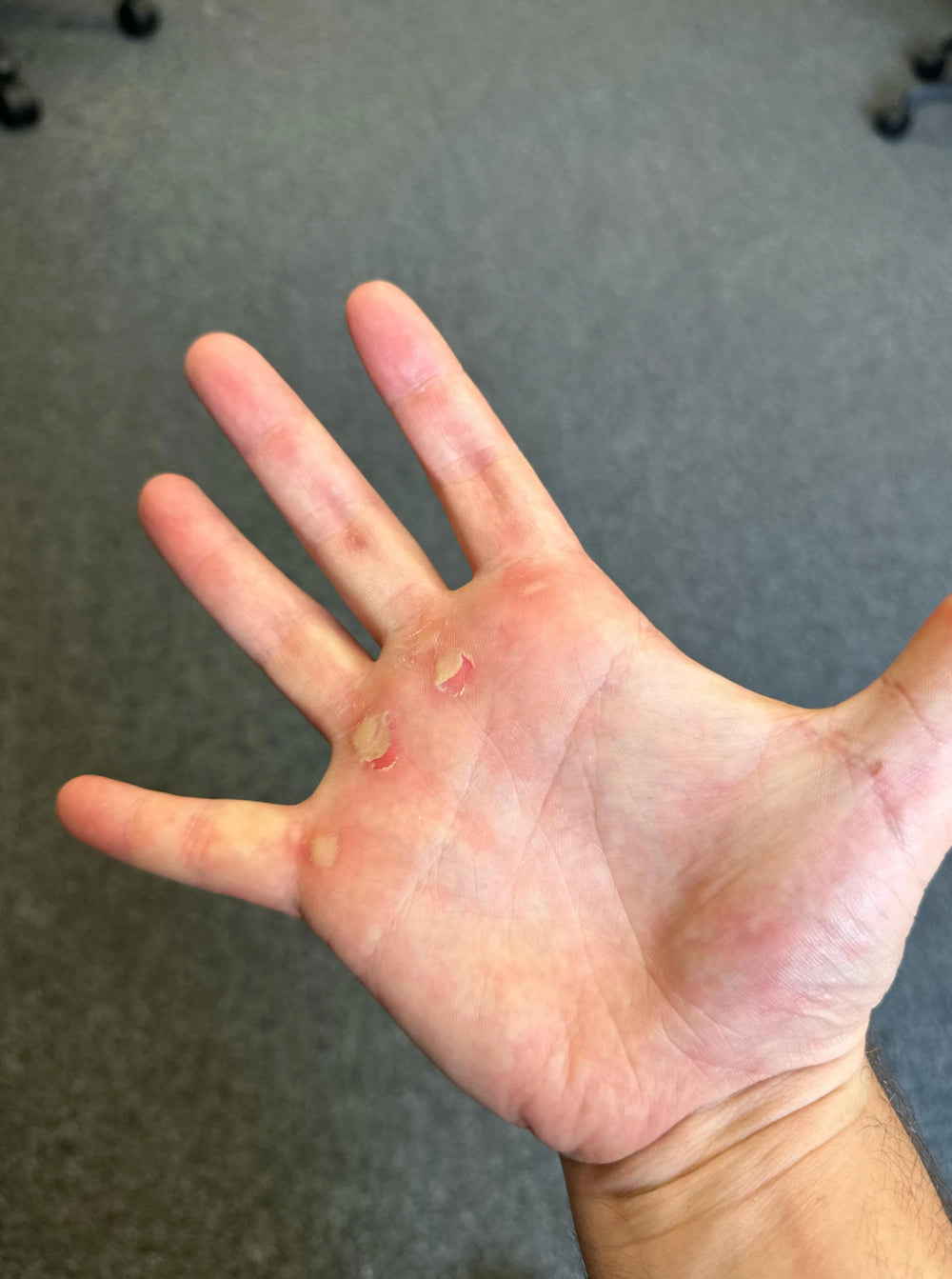 TORN HANDS. FORCED REST.